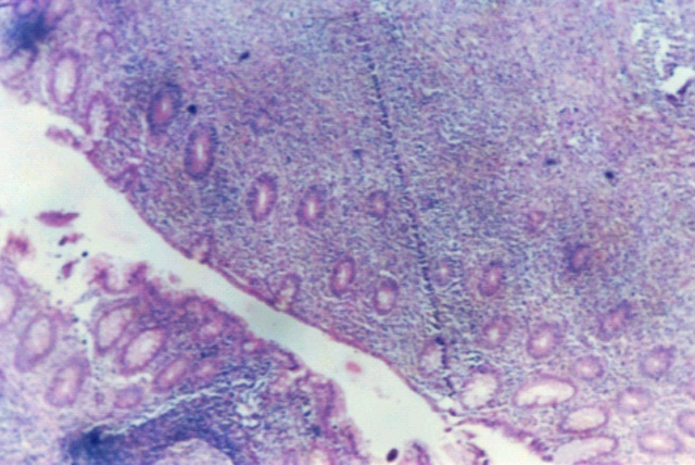 Fig. 1: Linfoma de tipo MZL-MALT. - <div style=